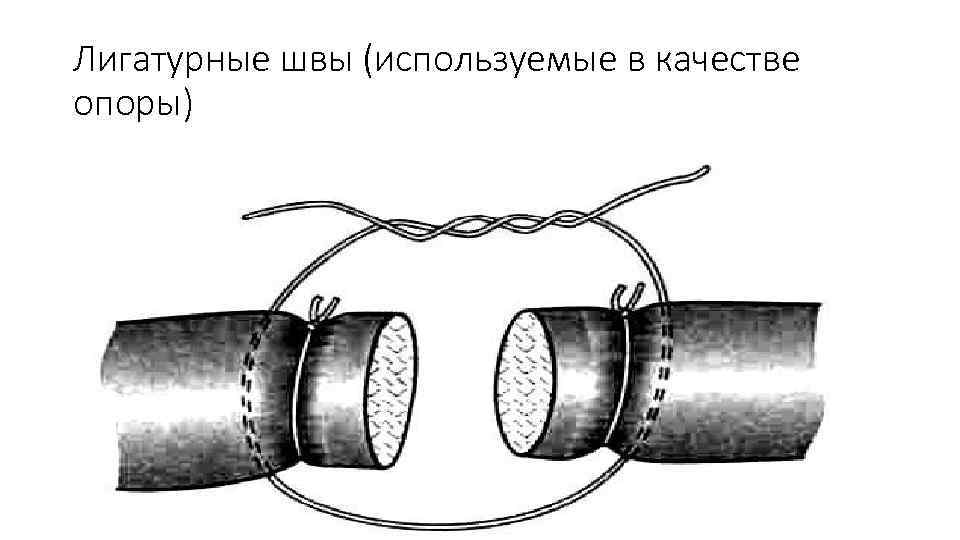 Лигатурные швы (используемые в качестве опоры) 