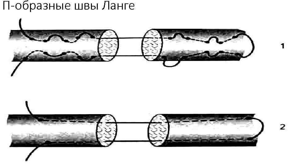 П-образные швы Ланге 
