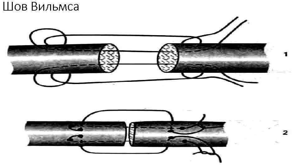 Шов Вильмса 