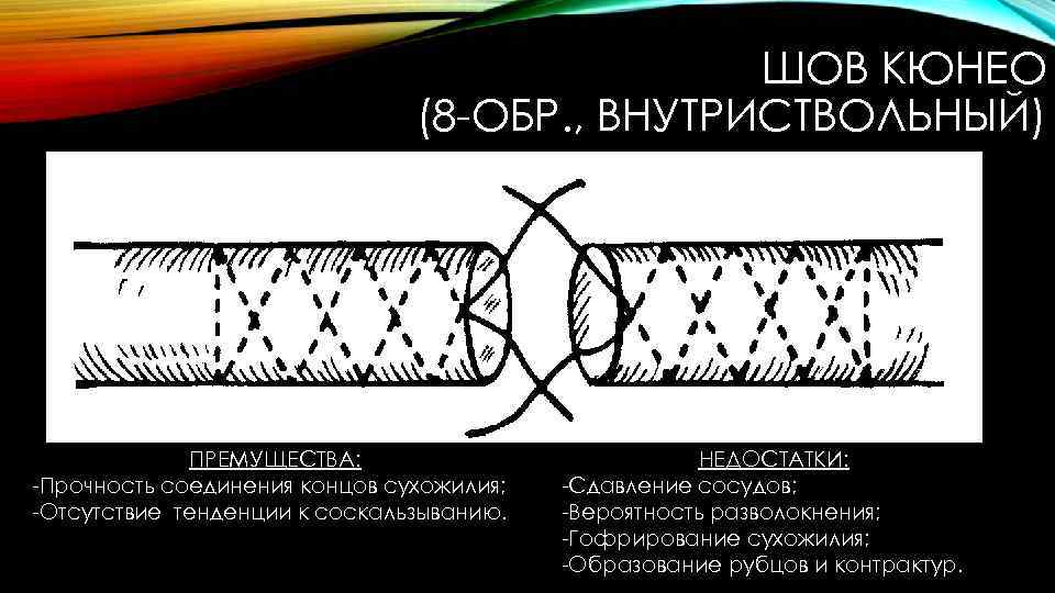 Конец соединения. Сосудистый шов Кюнео. Недостатки сухожильных швов. Шов Кюнео плюсы и минусы. Гофрирование линий шва.