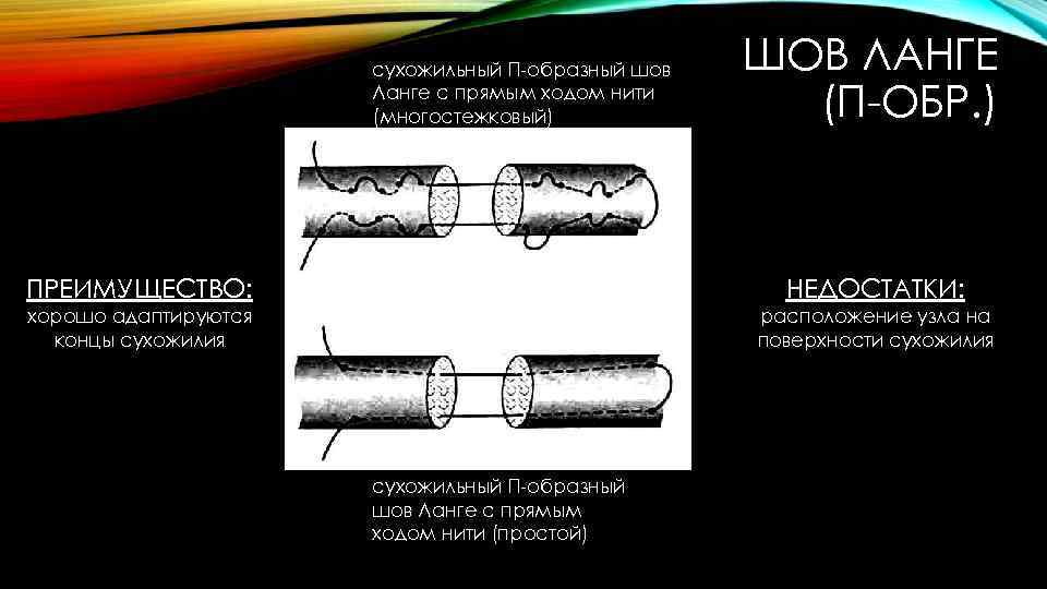 сухожильный П-образный шов Ланге с прямым ходом нити (многостежковый) ШОВ ЛАНГЕ (П-ОБР. ) ПРЕИМУЩЕСТВО: