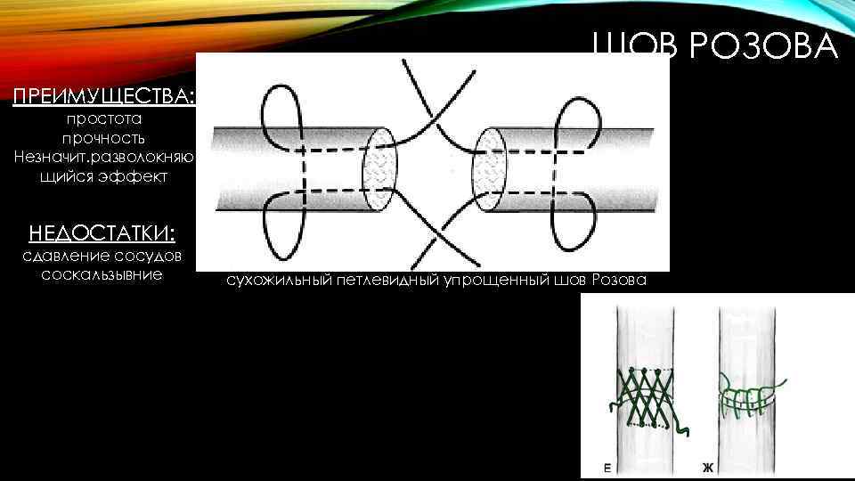 ШОВ РОЗОВА ПРЕИМУЩЕСТВА: простота прочность Незначит. разволокняю щийся эффект НЕДОСТАТКИ: сдавление сосудов соскальзывние сухожильный