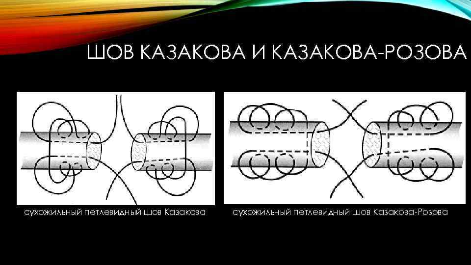 ШОВ КАЗАКОВА И КАЗАКОВА-РОЗОВА сухожильный петлевидный шов Казакова-Розова 