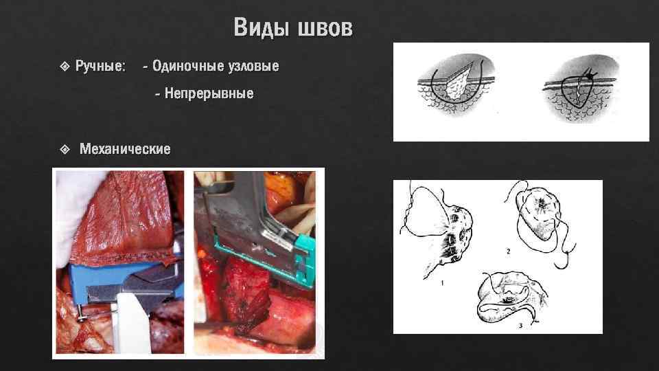 Виды швов Ручные: - Одиночные узловые - Непрерывные Механические 