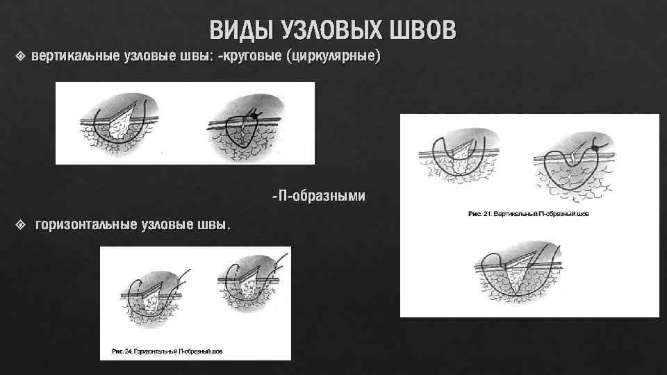 ВИДЫ УЗЛОВЫХ ШВОВ вертикальные узловые швы: -круговые (циркулярные) - П-образными горизонтальные узловые швы. 
