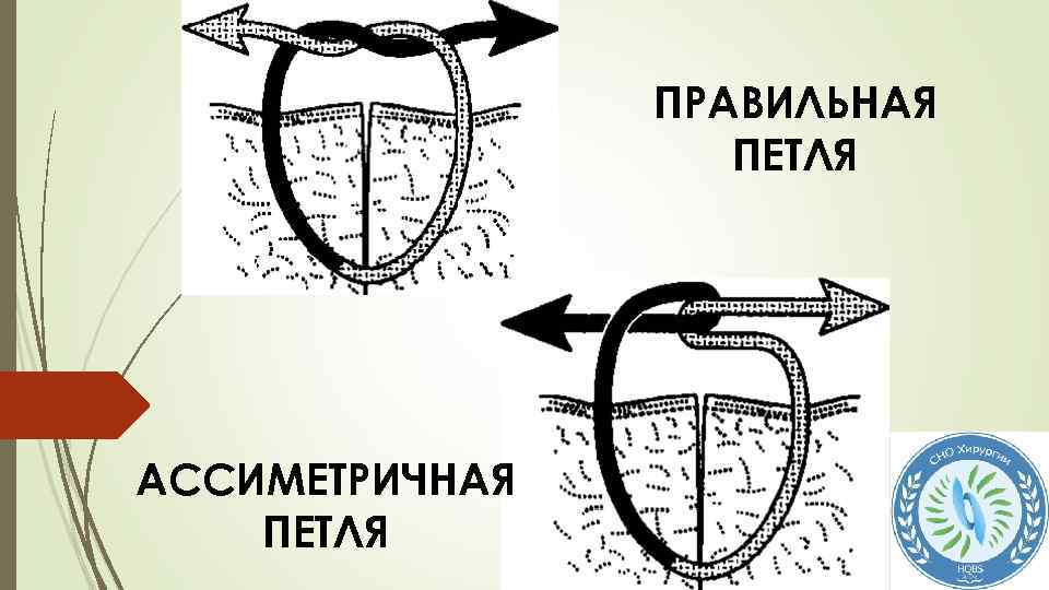 ПРАВИЛЬНАЯ ПЕТЛЯ АССИМЕТРИЧНАЯ ПЕТЛЯ 