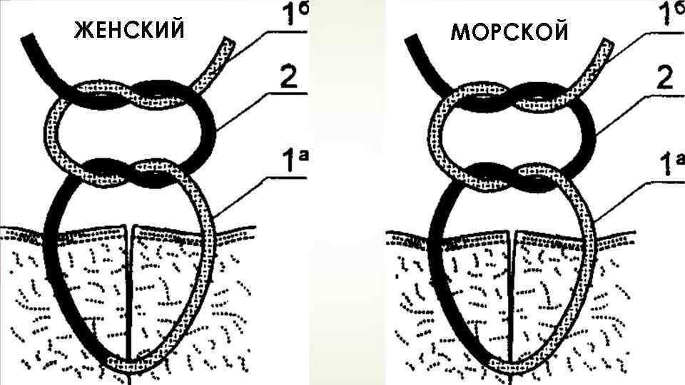 Кастрационная петля схема