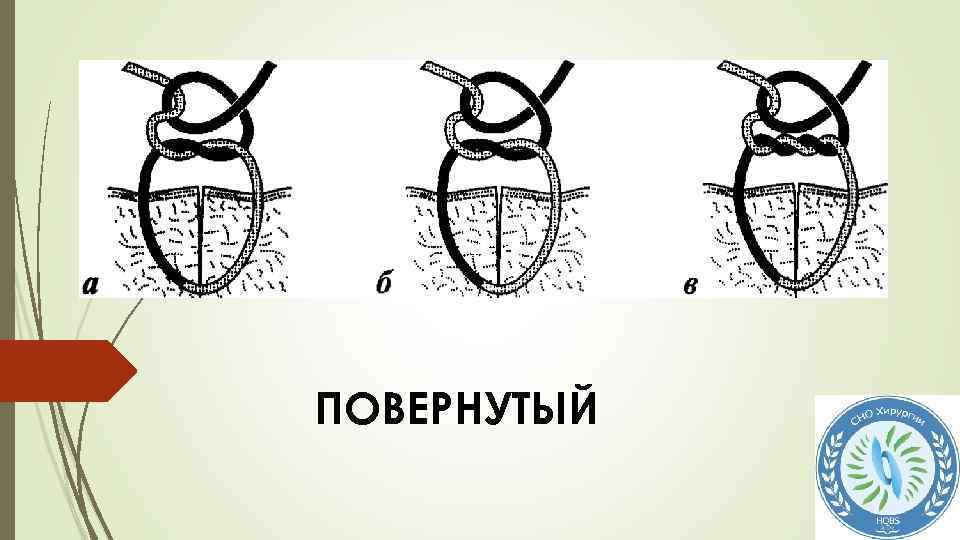 Шов нити. Академический узел в хирургии. Анкерный узел в хирургии. Повернутый узел хирургия.