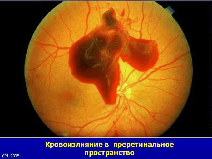 СМ, 2005 Кровоизлияние в преретинальное пространство 