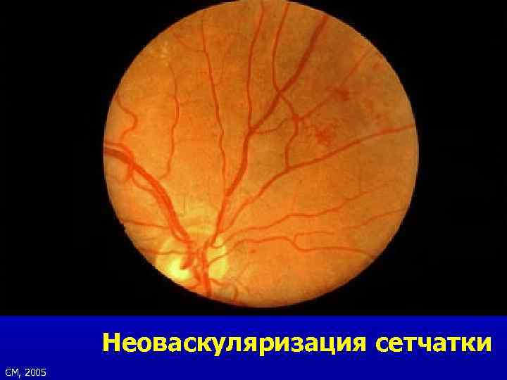 Неоваскуляризация сетчатки СМ, 2005 