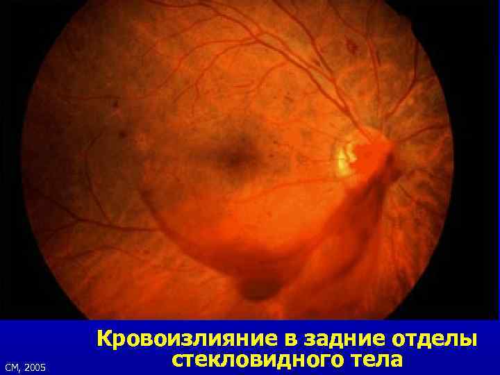 СМ, 2005 Кровоизлияние в задние отделы стекловидного тела 