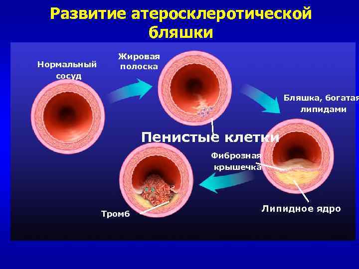 Развитие атеросклеротической бляшки Нормальный сосуд Жировая полоска Бляшка, богатая липидами Пенистые клетки Фиброзная крышечка