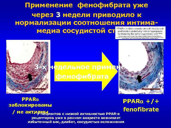Применение фенофибрата уже через 3 недели приводило к нормализации соотношения интима медиа сосудистой стенки!