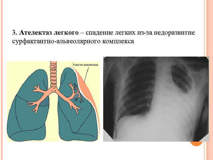 3. Ателектаз легкого – спадение легких из-за недоразвитие сурфактантно-альвеолярного комплекса 