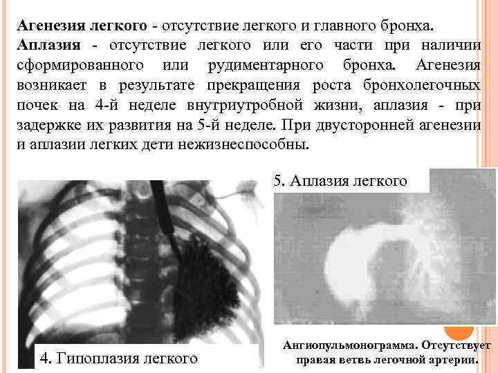 Агенезия легкого - отсутствие легкого и главного бронха. Аплазия - отсутствие легкого или его