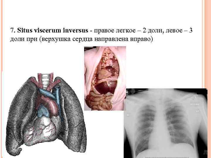 7. Situs viscerum inversus - правое легкое – 2 доли, левое – 3 доли