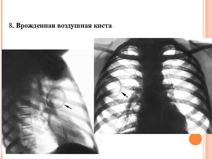 8. Врожденная воздушная киста 