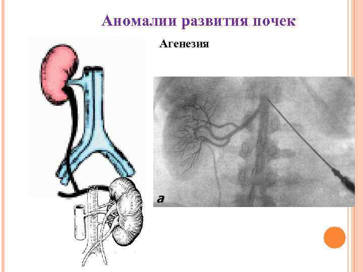 Аномалии развития почек Агенезия 