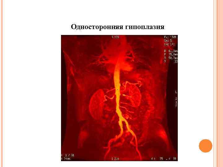 Односторонняя гипоплазия 