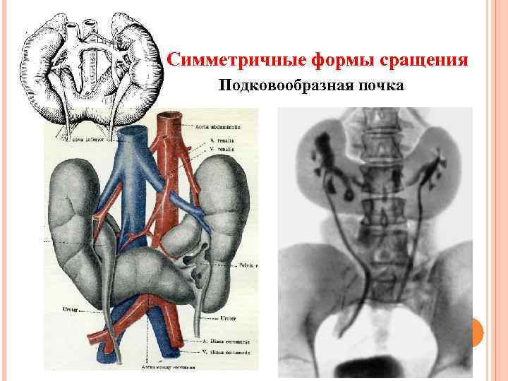 Симметричные формы сращения Подковообразная почка 