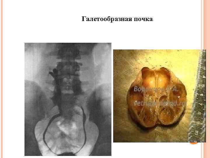 Галетообразная почка 