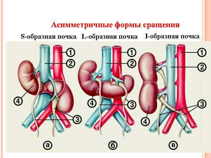 Асимметричные формы сращения S-образная почка L-образная почка I-образная почка 