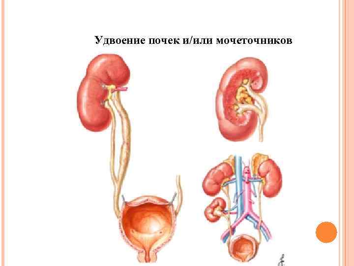 Удвоение почек и/или мочеточников 