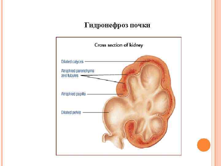 Гидронефроз почки 