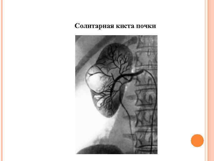 Солитарная киста почки 