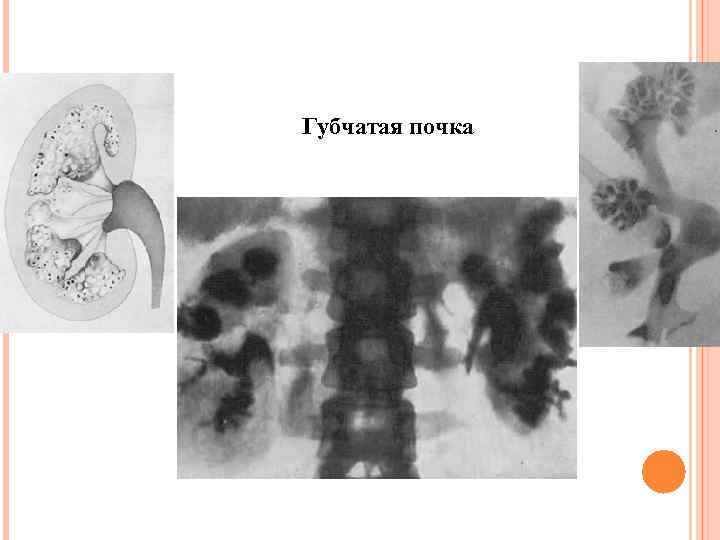 Губчатая почка 