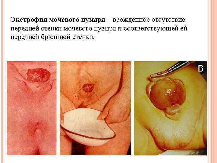 Экстрофия мочевого пузыря – врожденное отсутствие передней стенки мочевого пузыря и соответствующей ей передней