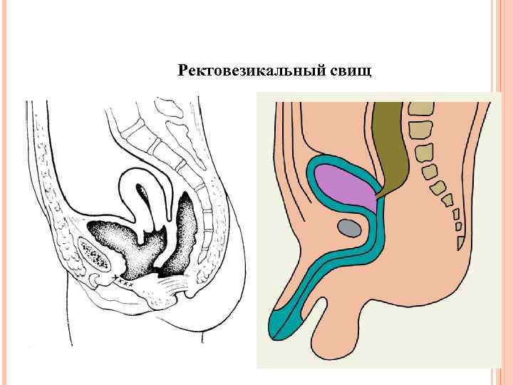 Ректовезикальный свищ 