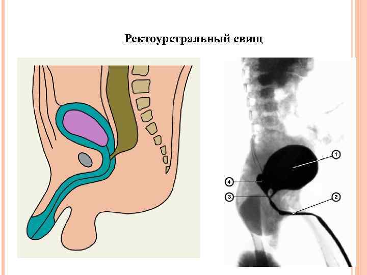 Ректоуретральный свищ 