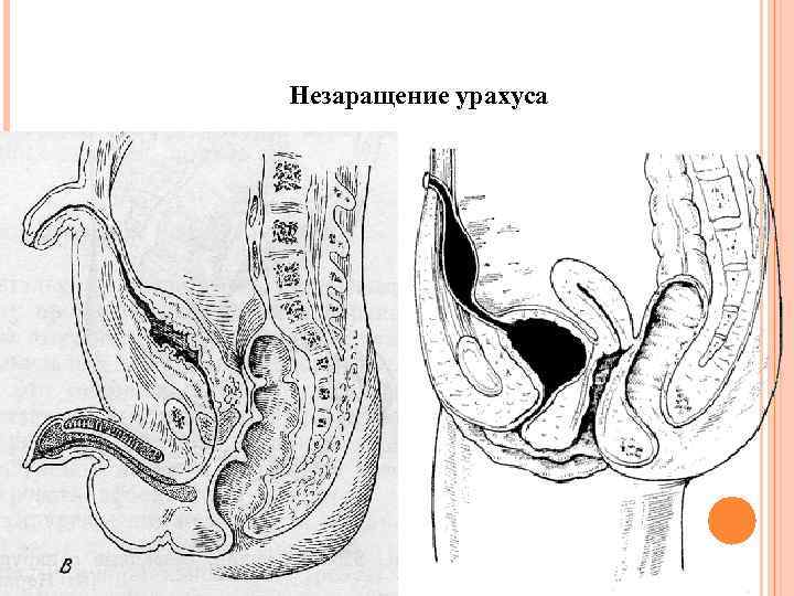 Незаращение урахуса 