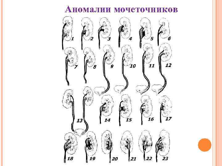 Аномалии мочеточников 