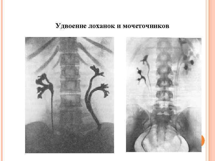 Удвоение лоханок и мочеточников 