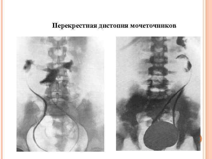 Перекрестная дистопия мочеточников 