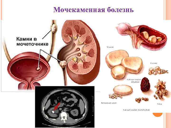Мочекаменная болезнь 