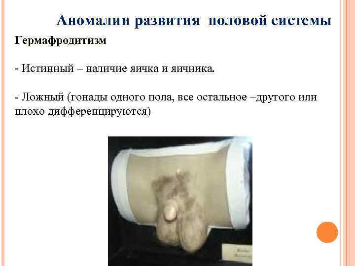 Аномалии развития половой системы Гермафродитизм - Истинный – наличие яичка и яичника. - Ложный