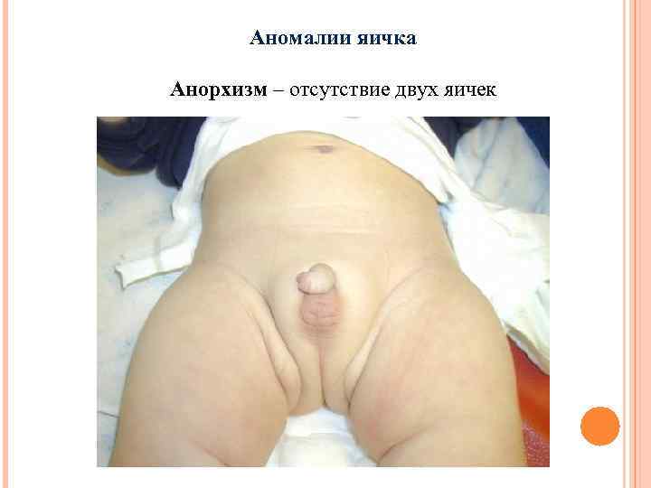 Аномалии яичка Анорхизм – отсутствие двух яичек 