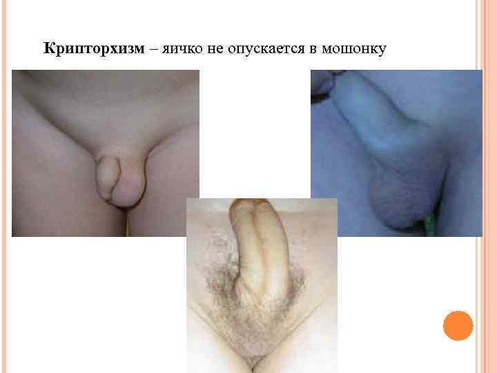 Крипторхизм – яичко не опускается в мошонку 