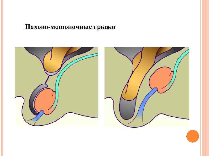 Пахово-мошоночные грыжи 