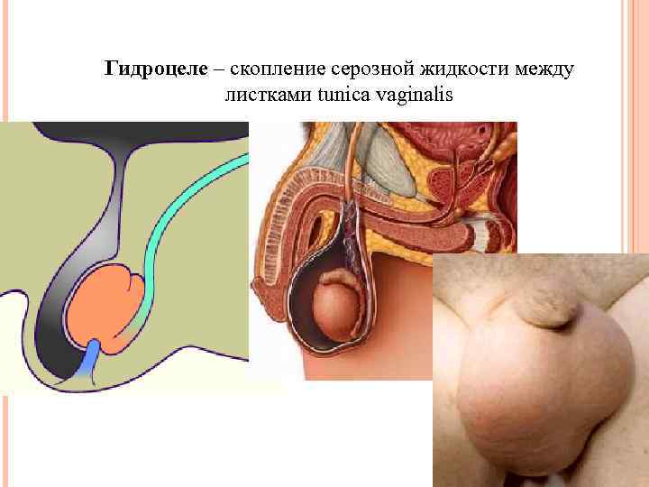 Гидроцеле – скопление серозной жидкости между листками tunica vaginalis 