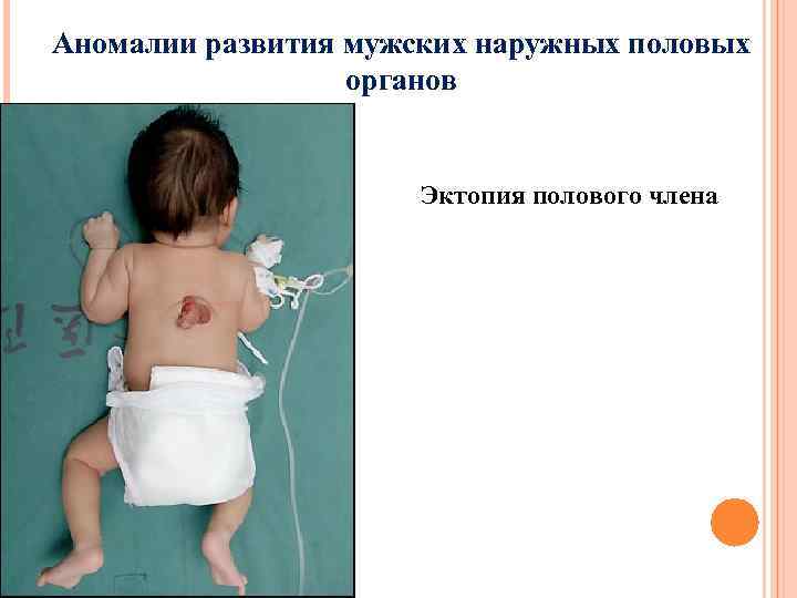 Аномалии развития мужских наружных половых органов Эктопия полового члена 