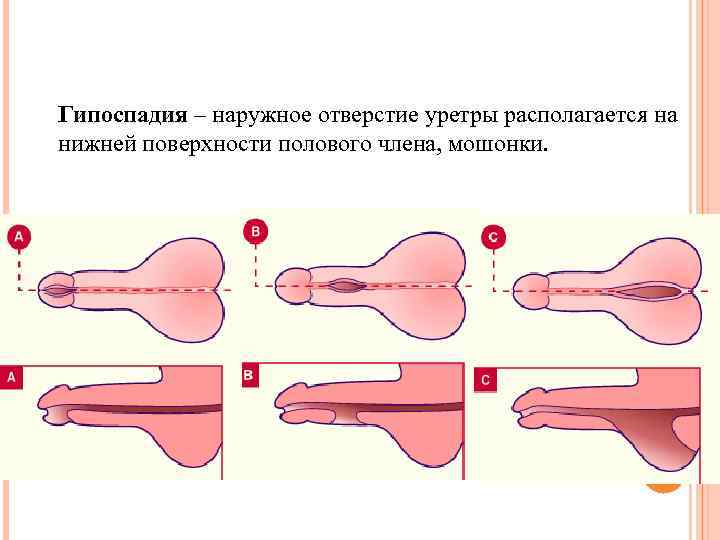 Гипоспадия – наружное отверстие уретры располагается на нижней поверхности полового члена, мошонки. 