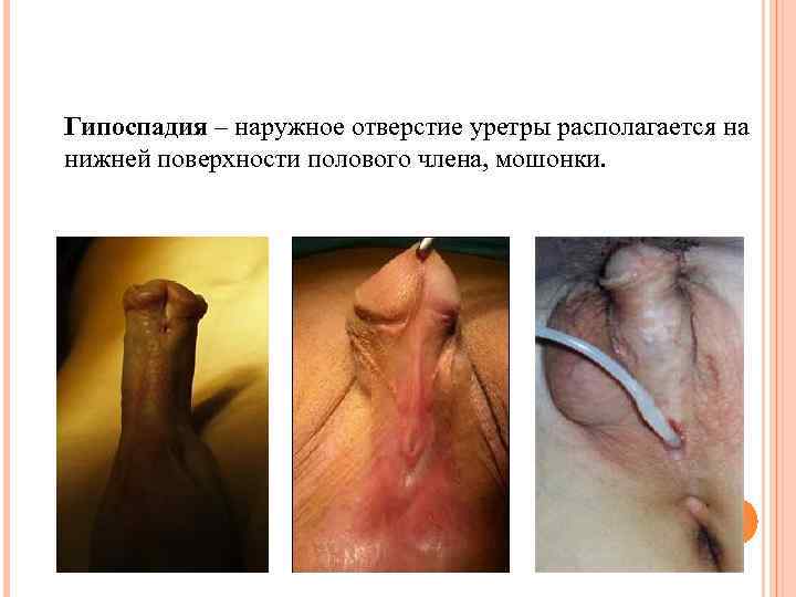 Гипоспадия – наружное отверстие уретры располагается на нижней поверхности полового члена, мошонки. 
