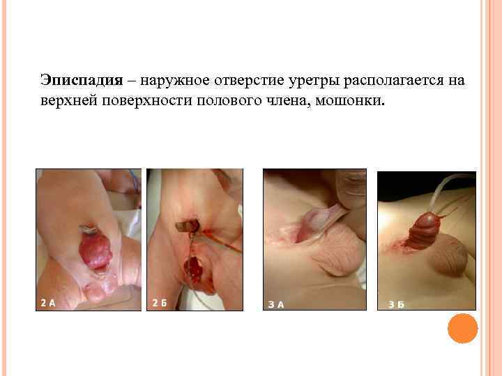 Эписпадия – наружное отверстие уретры располагается на верхней поверхности полового члена, мошонки. 