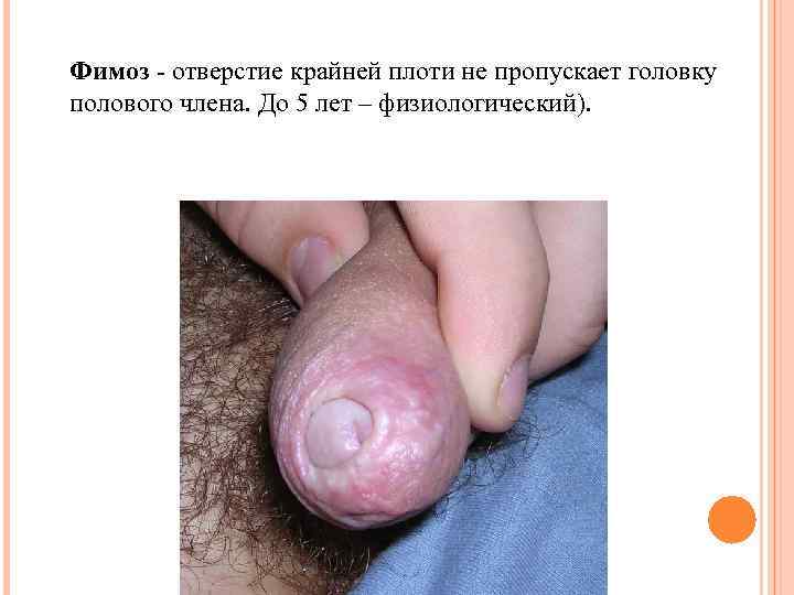 Фимоз - отверстие крайней плоти не пропускает головку полового члена. До 5 лет –