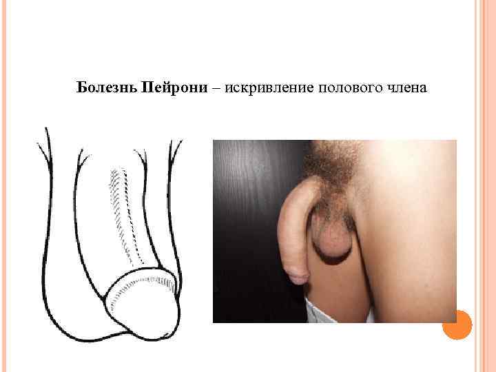 Болезнь Пейрони – искривление полового члена 