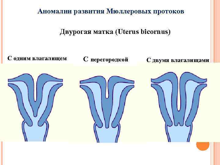 Аномалии развития Мюллеровых протоков Двурогая матка (Uterus bicornus) С одним влагалищем С перегородкой С